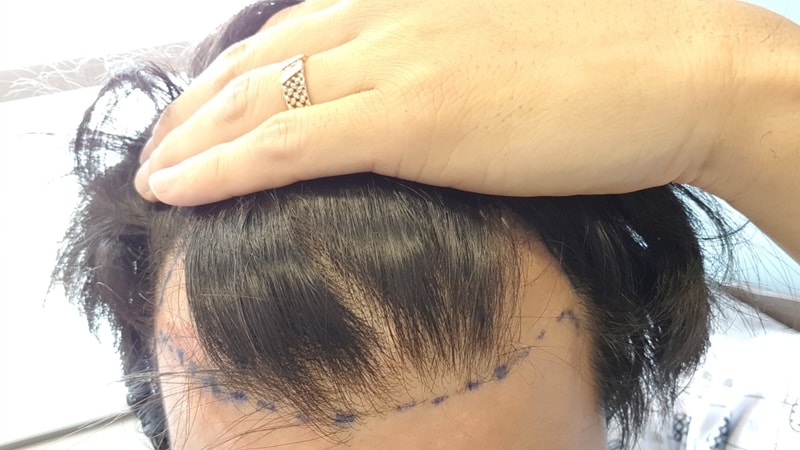 The day after Mo Plus' 3,000 hair loss surgery