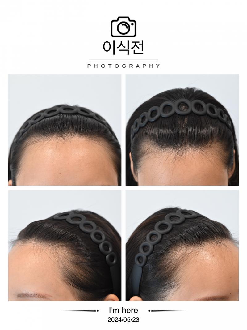 모엠 히든컷 1년경과