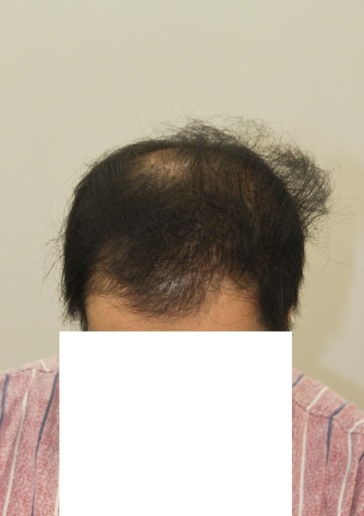mass transplant review