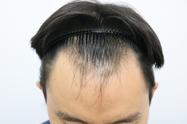 M.J.手术已经9个月了