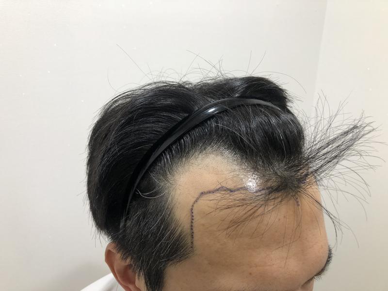 3616모 절개식 3달 경과