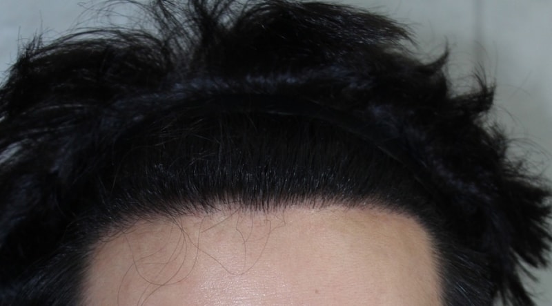 2500 hannabe incisions. 1 year of photos and now 2 years of reviews