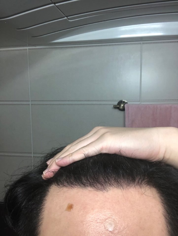 뉴헤어 절개 6개월차(3400모)