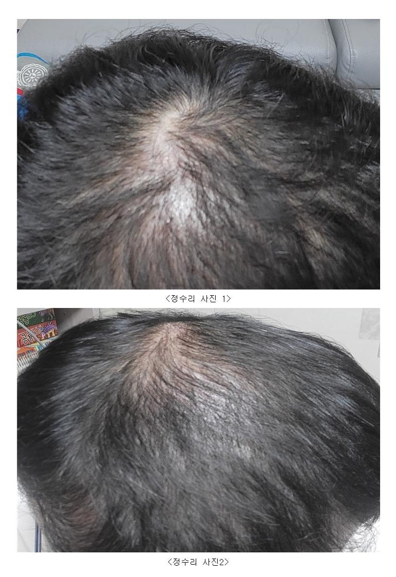 Late stage after 4 months of hair transplantation