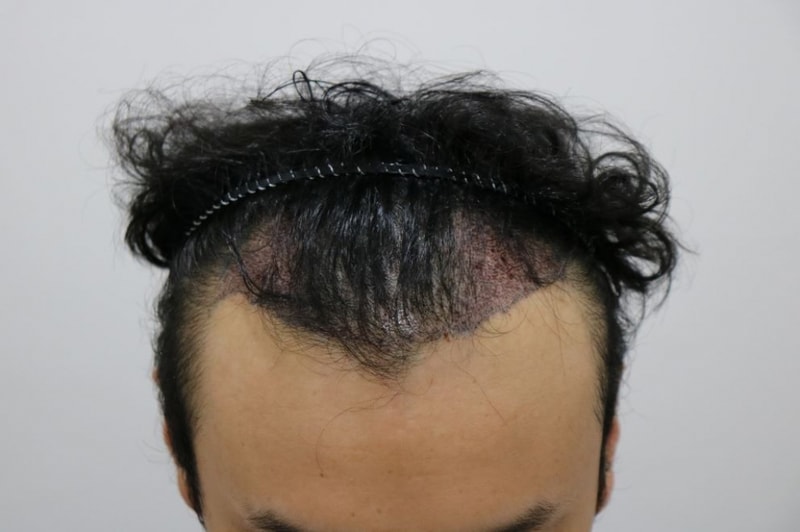 수술당일.JPG