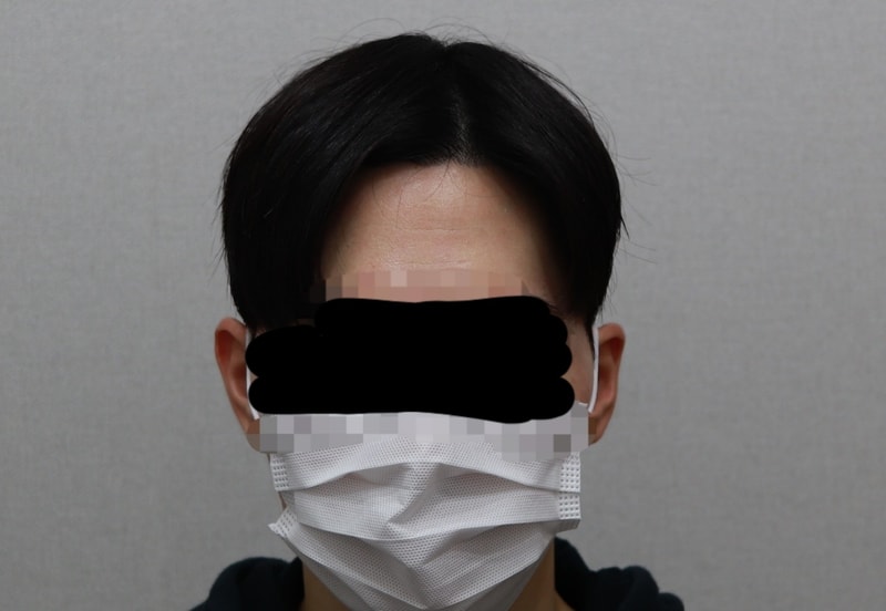 수술 후 내린머리.jpg