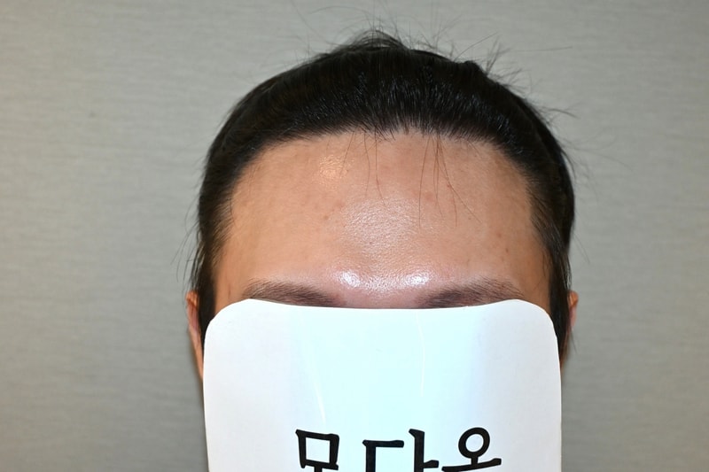 에프터.jpg
