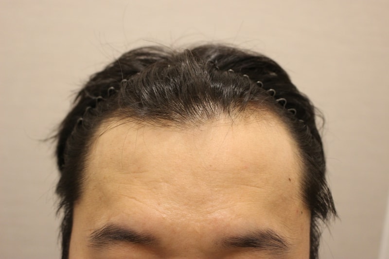 수술전.jpg