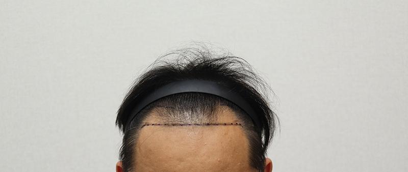 수술 전 정면.JPG