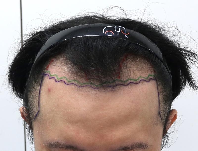 狎鴎亭 マンモス ヘアライン 医院 非切開 スリット 毛髪移植4ヵ月目 レビュー