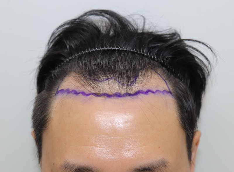 고밀도, 고생착 비절개슬릿 대구 포헤어의원 비절개모발이식 4달후기