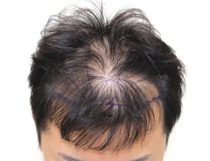 너무너무너무 만족합니다! 대구 포헤어 비절개슬릿 모발이식 9개월 후기