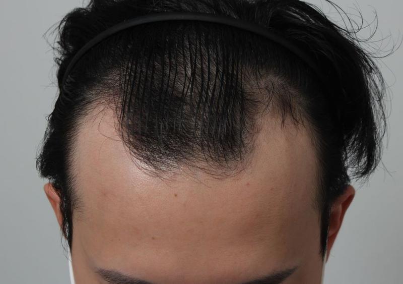 20代半ばで釜山ポヘアで非切開毛髪移植を受けました