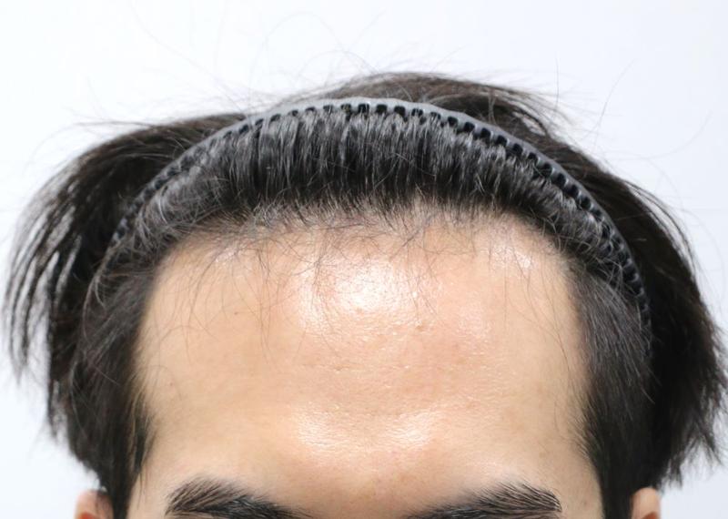 채취와 이식을 동시에_압구정 포헤어 비절개모발이식 1달차 암흑기