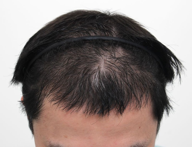 부산 포헤어 가발 대신 선택한 비절개모발이식 수술당일 후기