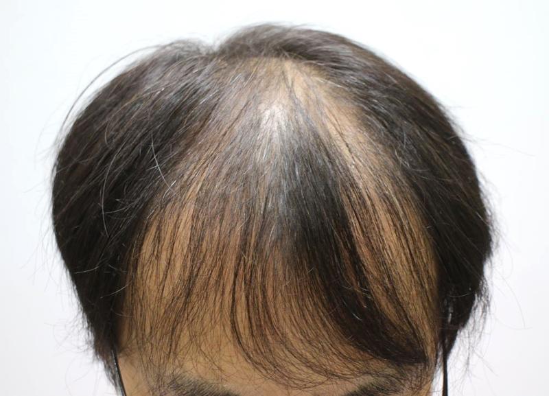 Hair split solution fuller hair Daegu pohair non-cut slit 9 months review