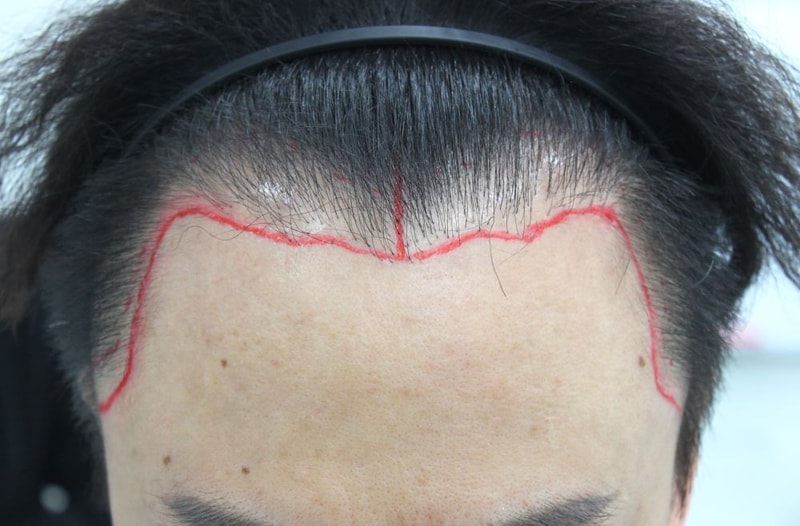 Busan Pohair Density Reinforcement After Elliptic Failure Late 1st Month of Non-Cutting Hair Transplantation