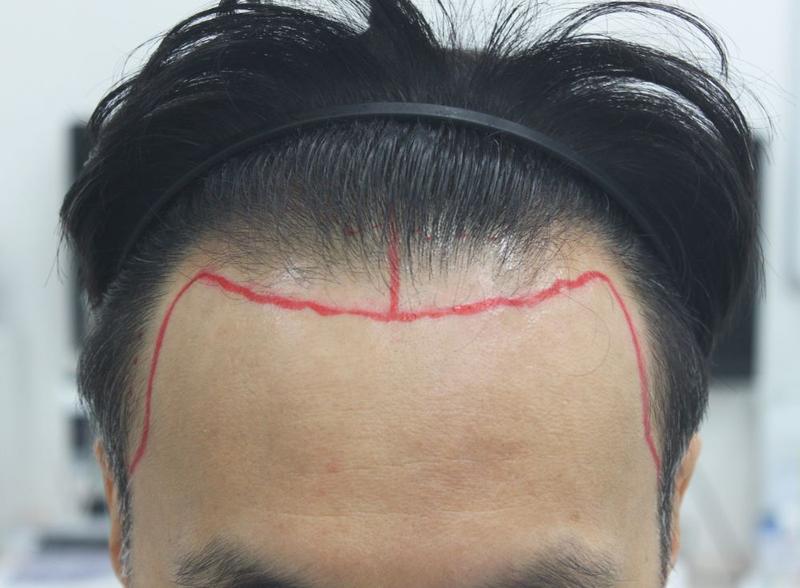 周围的反应非常热烈 釜山FORHAIR M型脱发非切开毛发移植5个月后期