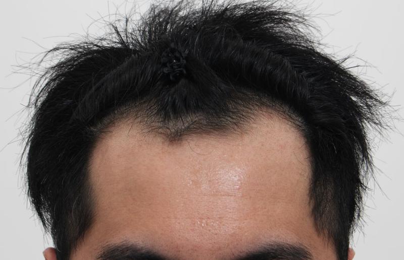 採取と移植を同時に釜山ポヘア非切開無削髪毛髪移植2週目後期