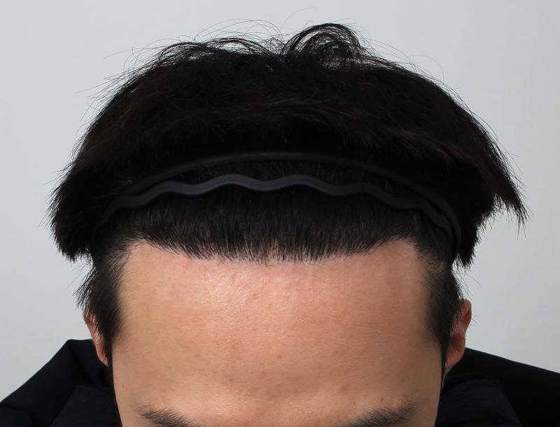 이렇게 달라지네요. 부산 포헤어 m자탈모 비절개모발이식 9개월 후기