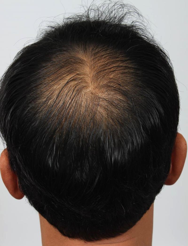 お金に値しますね。4ヶ月頭頂部効果、釜山ポヘア非切開毛髪移植、パク·サンゴン院長