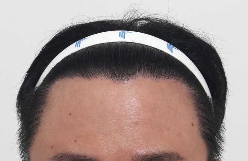 03.포헤어에서 재수술후 8개월차.JPG