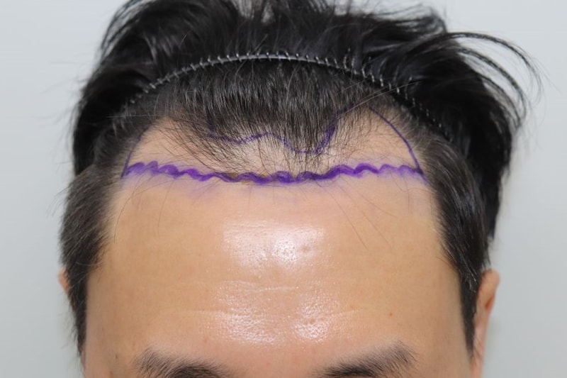 고밀도, 고생착 비절개슬릿 대구 포헤어의원 모발이식 10개월 후기