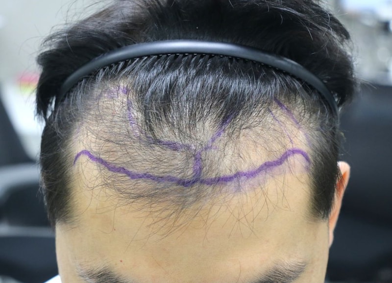 我把它交给了30多岁严重的脱发Four Hair 狎鸥亭非切开毛发移植第1个月后期