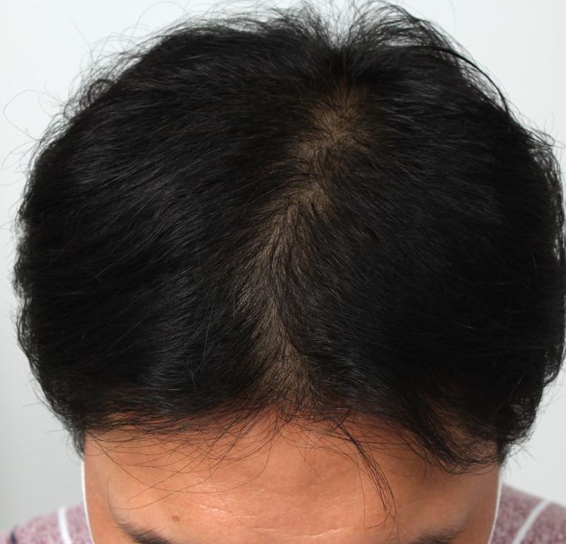 8 months of Busan Po Hair Non-cut Hair Transplantation in Busan Po Hair, which has become fuller + flat