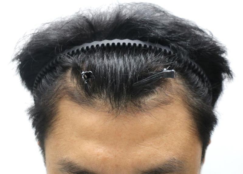 [Apgujeong Four Hair] M-shaped hair loss non-cut hair transplant 1491 hair follicle 7 months later