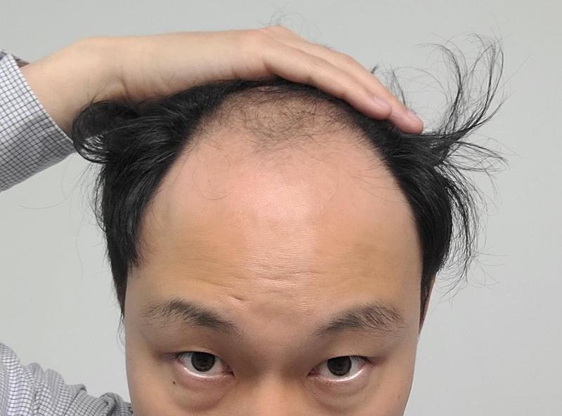 首尔FOHAIR医院非切开毛发移植4034发量移植的第4个月后期
