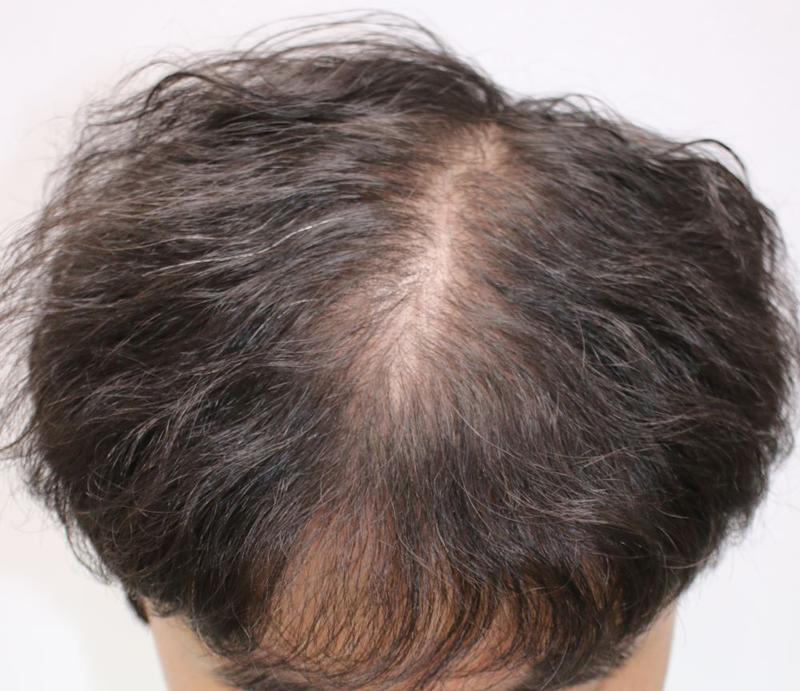中分脱发+发际线矫正 大邱Four Hair非切开毛发移植 4 个月后期