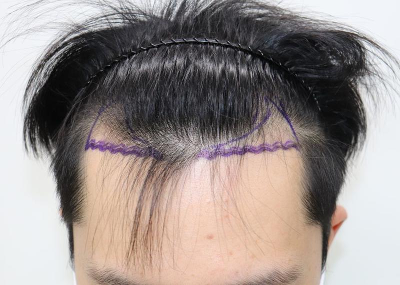 M-shaped hair loss + upper limb non-cut hair transplant Daegu Pohair surgery day review