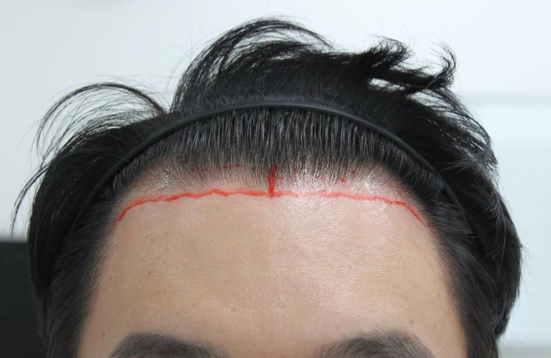 Men's Hairline Correction Busan Seo-myeon Forehead Clinic Non-cut Hair Transplantation for 4 months