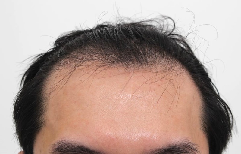 4개월차에도 만족스러워요 부산 포헤어의원 비절개슬릿 모발이식 4개월 후기