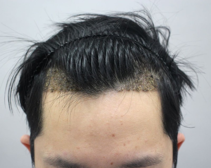 03.수술2주차.JPG