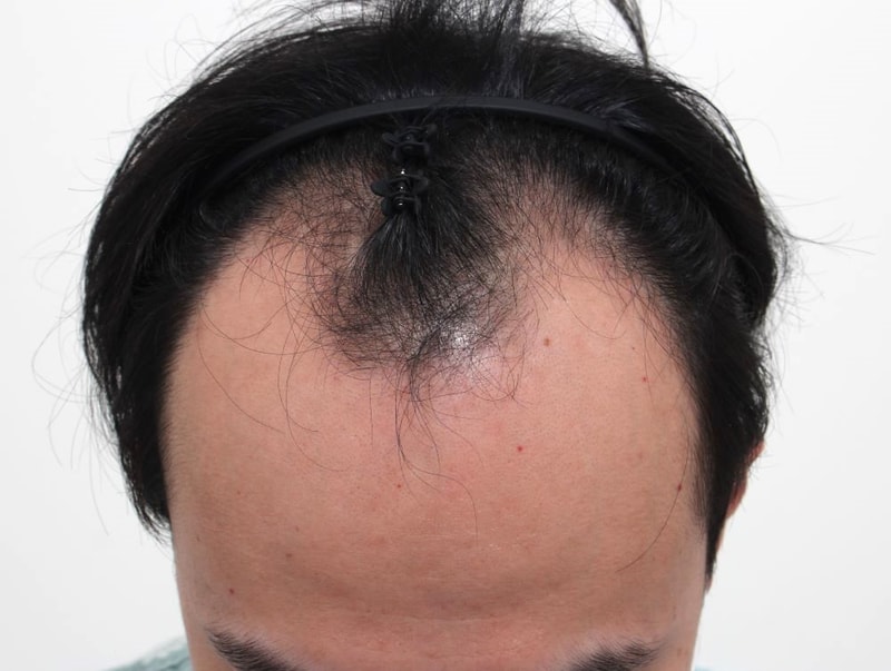 프리미엄 모발이식병원 부산 포헤어 비절개슬릿 5개월 풍성해진 머리숱