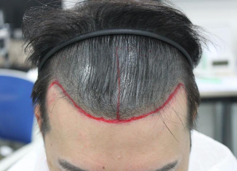 First-year review of non-intersected slit at Busan For Hair Clinic after scalp tattoo failure