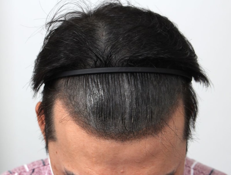 03.수술전.JPG