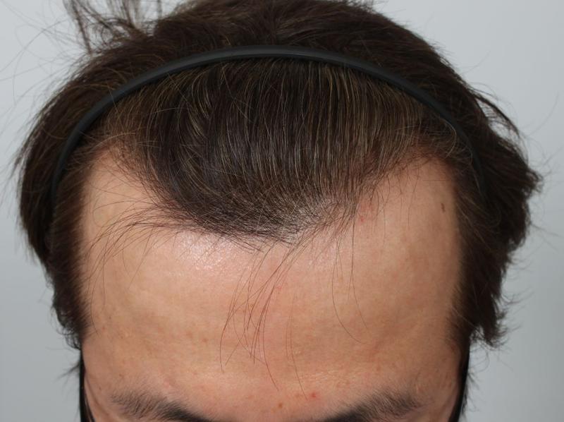 I think the birth rate is definitely high. Review of Busan Po Hair Non-Sectionless Hair 8 Months