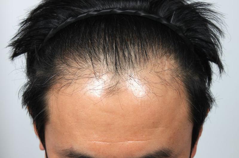 헤어라인 3cm 내렸습니다  부산포헤어 비절개모발이식 1달 암흑기