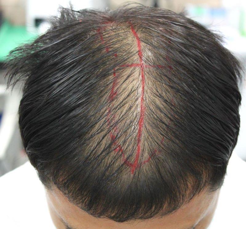 Busan Po Hair Non-Sectional Hair Transplantation Jeondubu + Jeongsu Hair Hair Removal 4-month Review