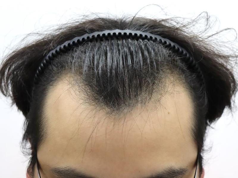 Apgujeong Pohair M-shaped hair loss non-cut hair transplantation 1 month into the dark age