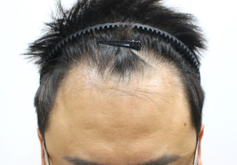 狎鴎亭フォーヘアのミン·ヨンギ院長！ M字脱毛 非切開毛髪移植(スリット) 1ヶ月目 レビュー