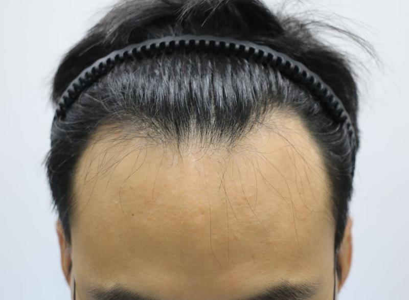 I finally got a non-cut hair transplant from my forehair the day after the operation