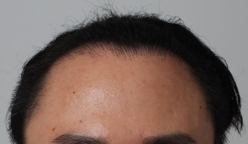 Busan Pohair Density Reinforcement After Oval Failure Late 8th Month of Non-cut Hair Transplantation