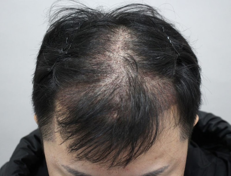 05.수술2주차.JPG