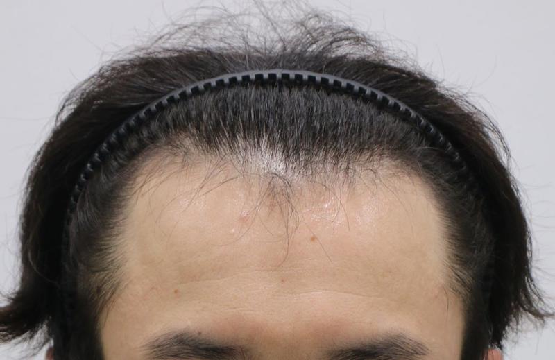 100% 만족 반듯한 이마라인 대구포헤어 비절개모발이식 6개월 후기
