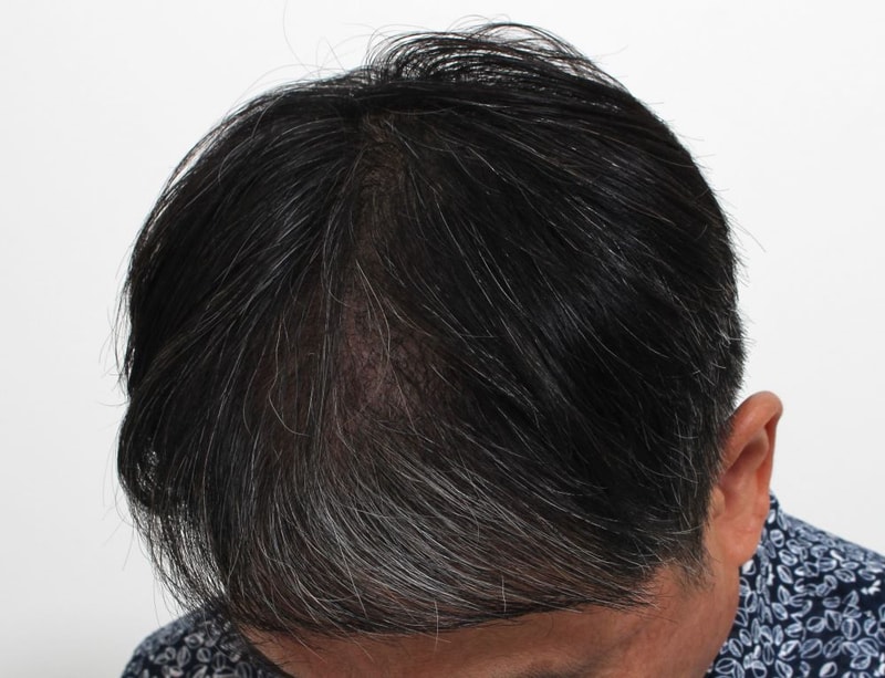 06.수술4개월.JPG