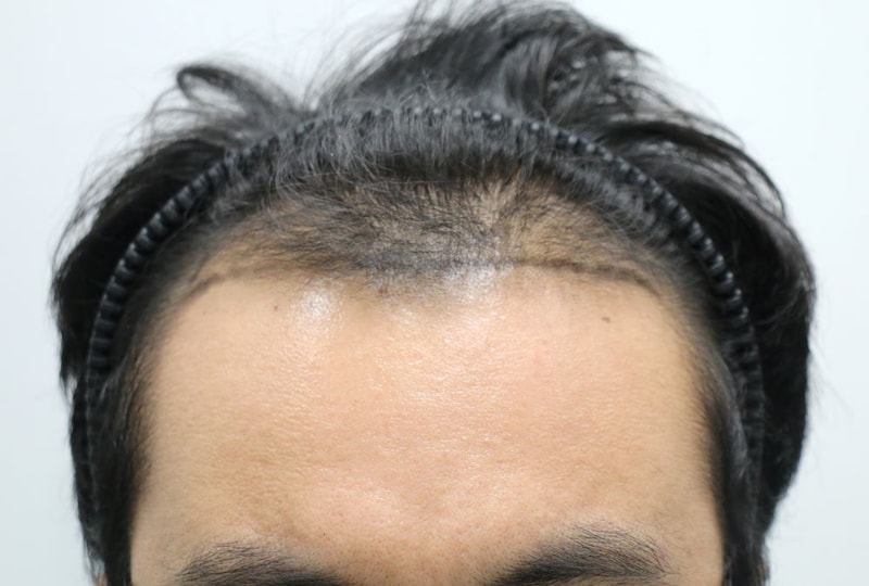 압구정 포헤어 M자+전두부탈모 비절개슬릿 모발이식 수술당일 후기